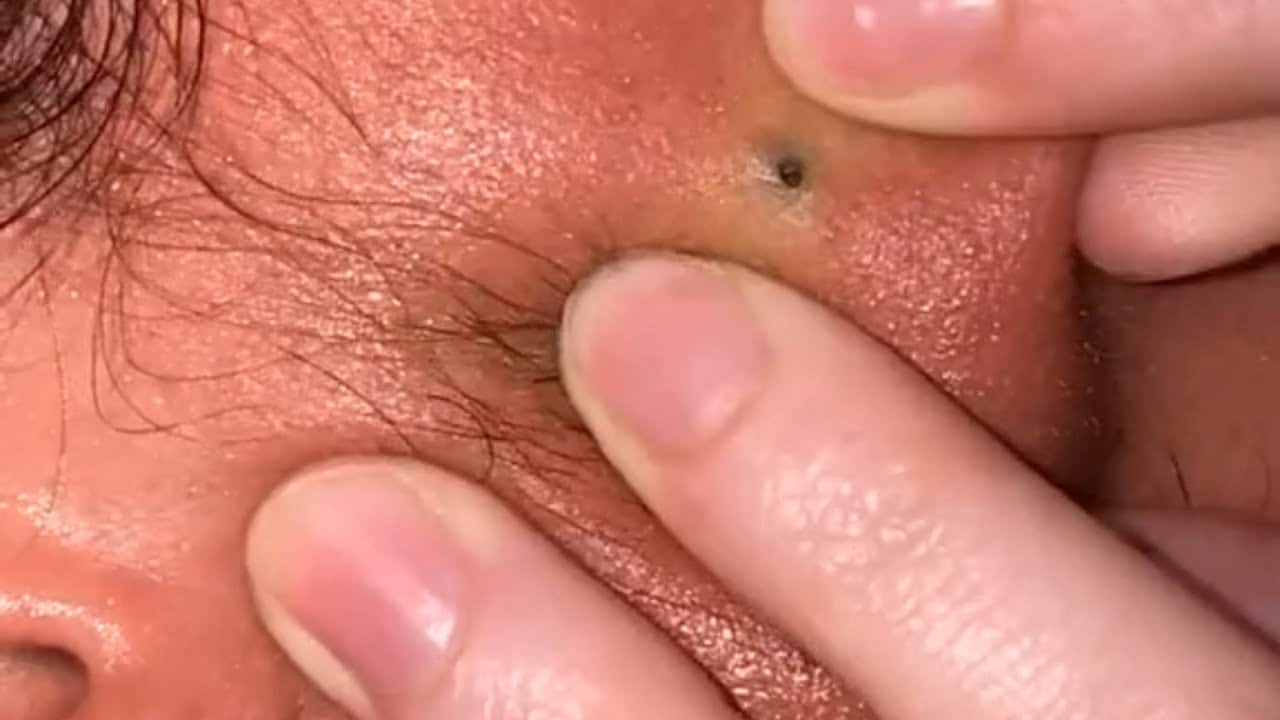 The Most Satisfying Pimple Popping