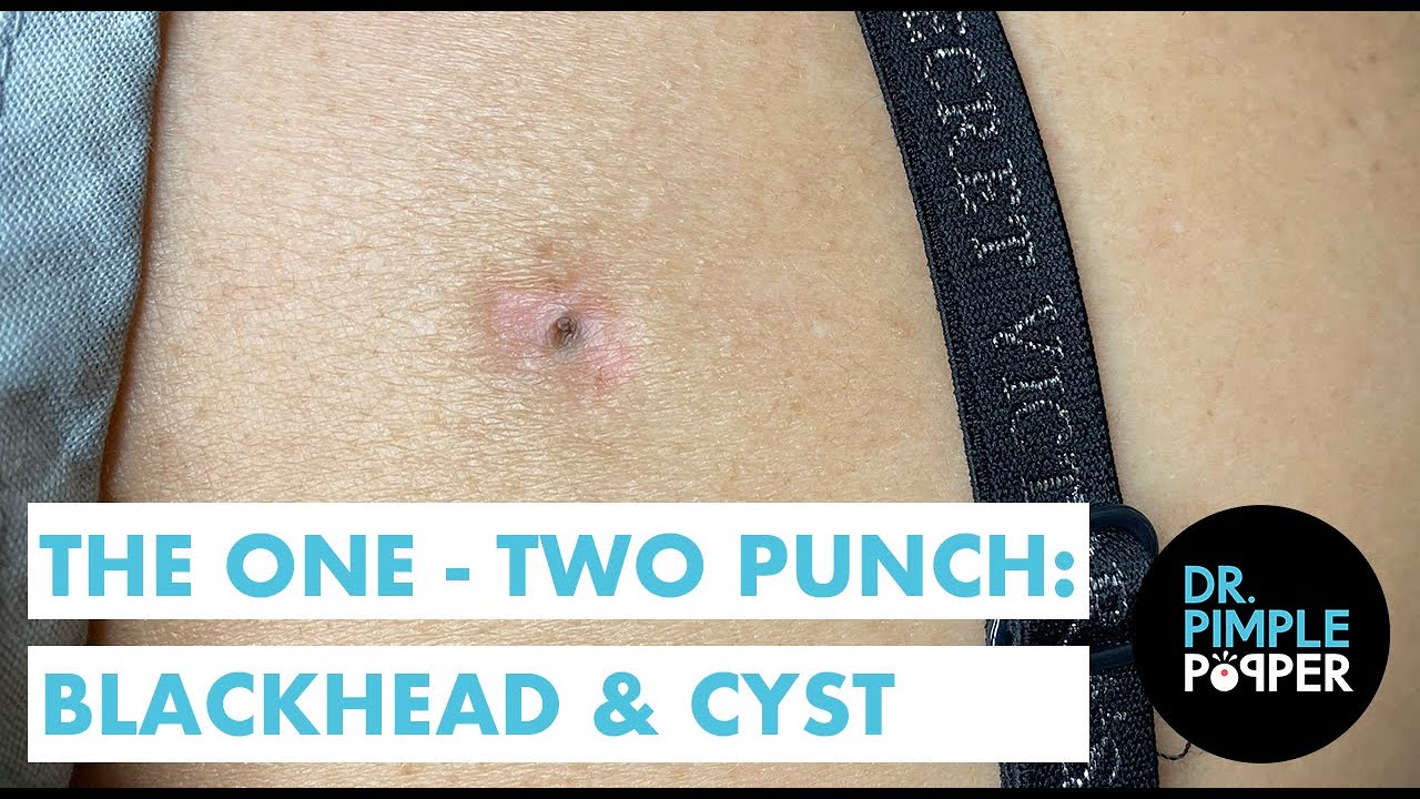 The One-Two Punch: Blackhead & Cyst