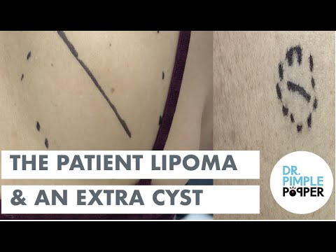 The Patient Lipoma and Extra Cyst