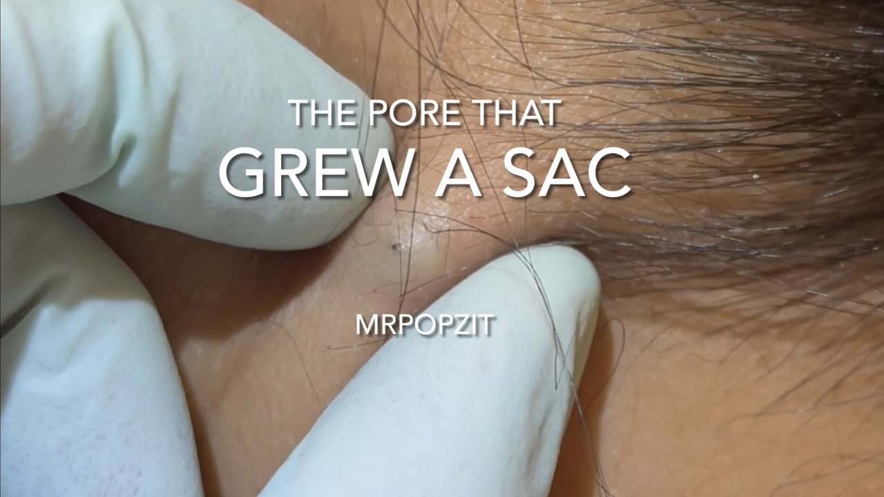 The pore that grew a sac. Yellow pasty cyst pop. Cyst excision on neck. MrPopZit.