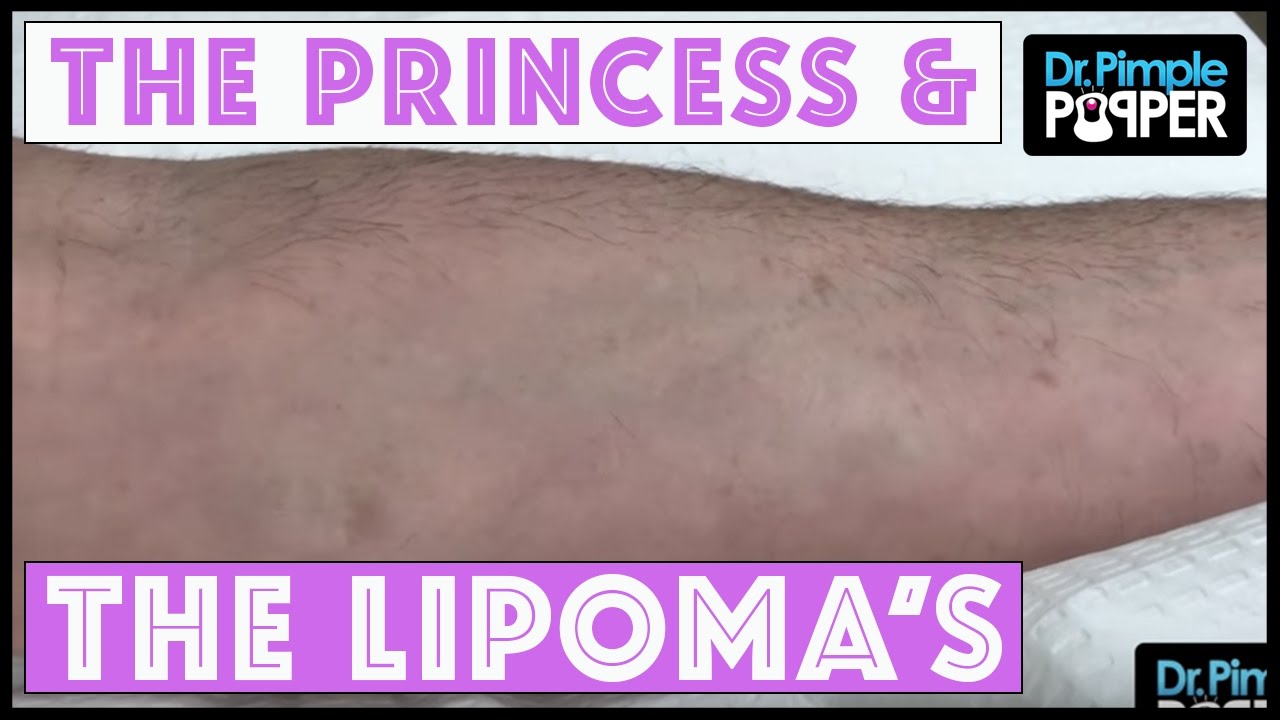 The Princess 👸🏻  & The Lipoma 🌝