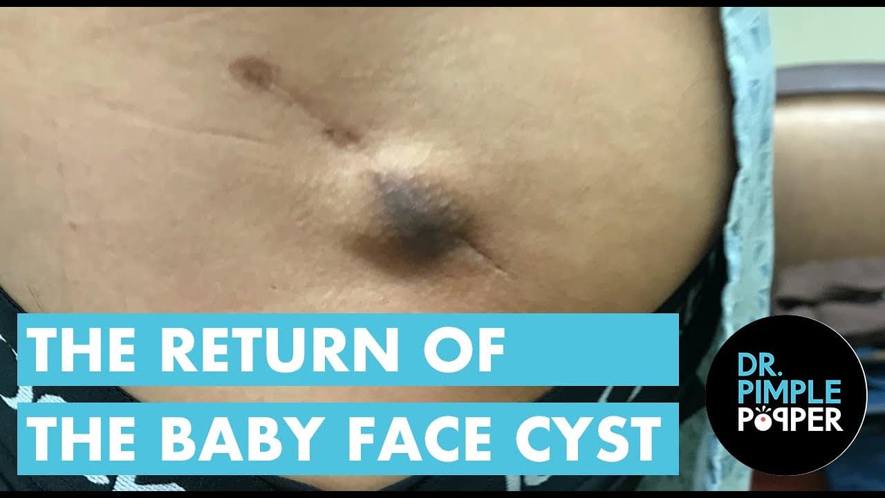 The Return of the Baby Face Cyst