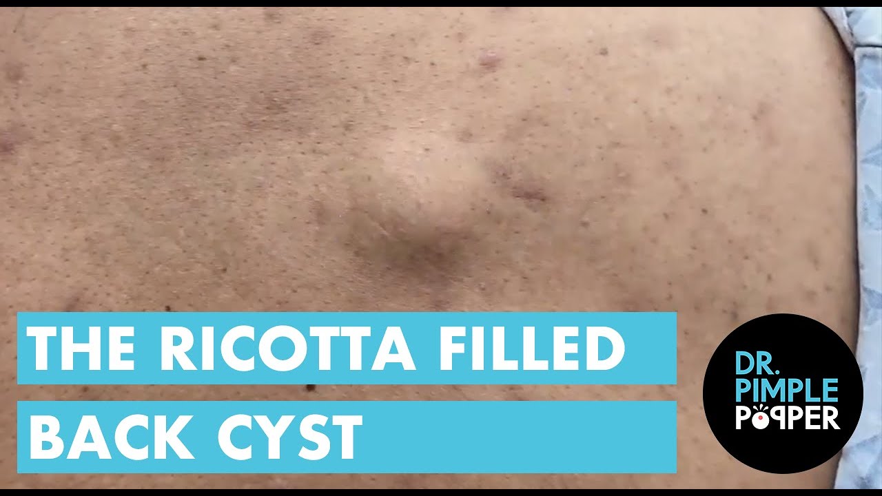 The Ricotta Filled Back Cyst