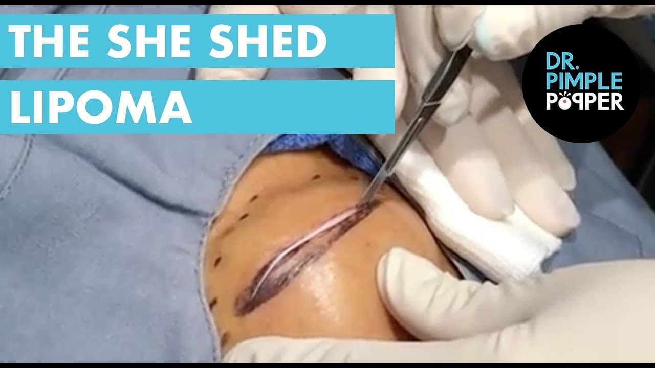 The She Shed Lipoma