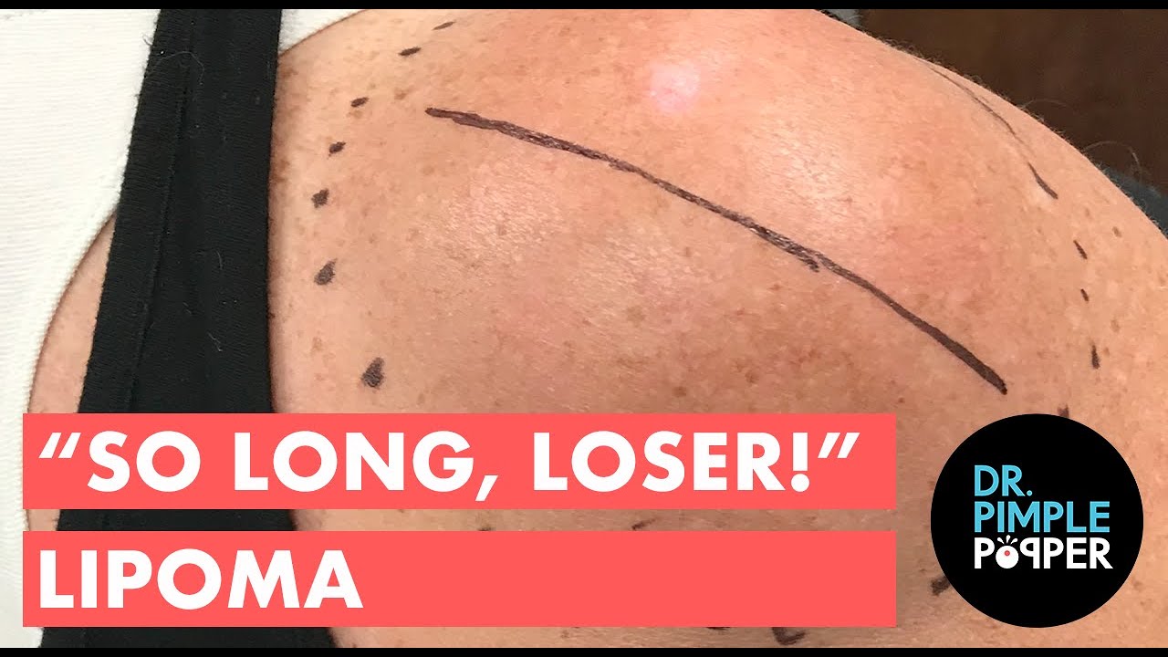 The “So Long, Loser!” Lipoma