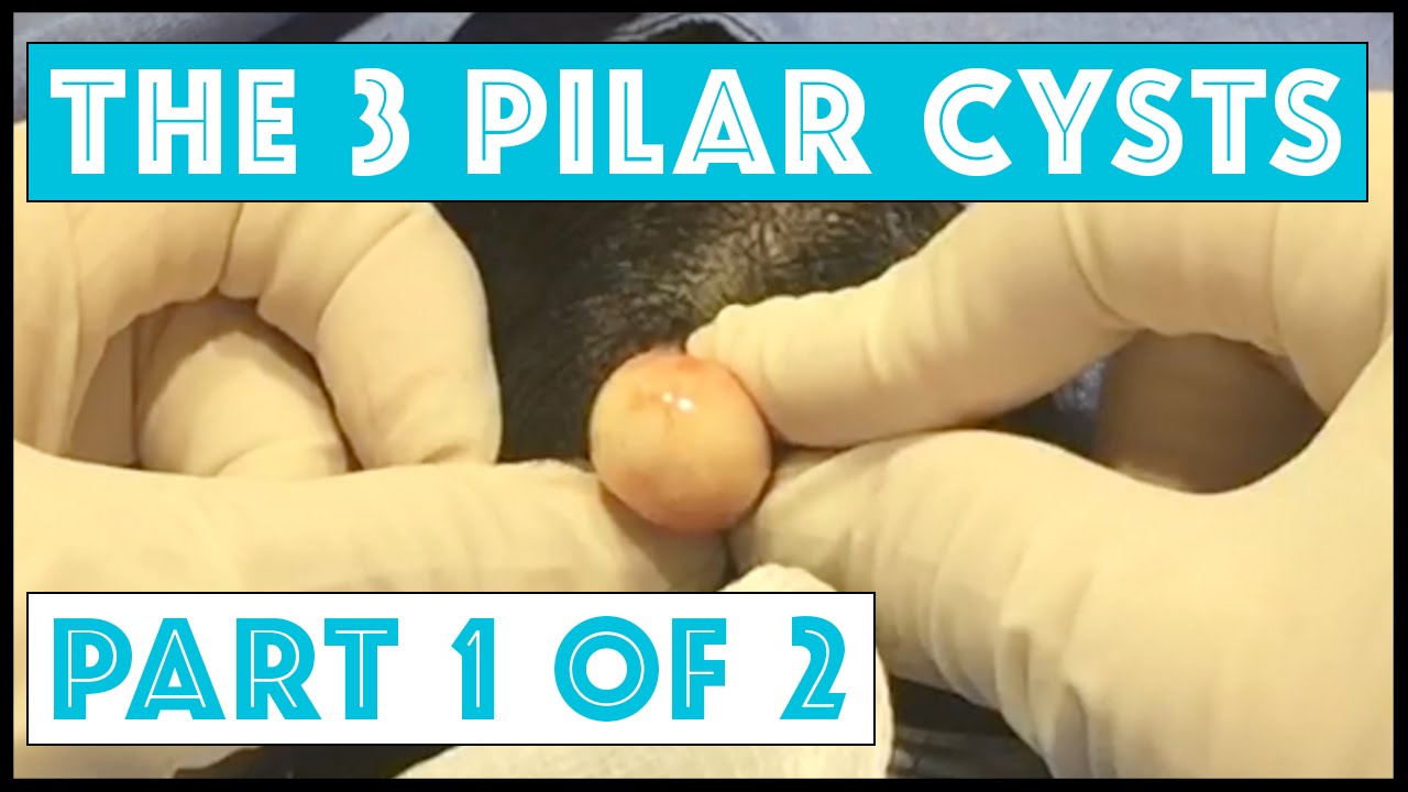 The Story of 3 Pilar Cysts: Part 1 of 2