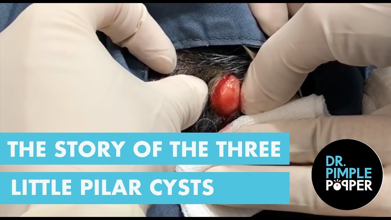 The Story of the Three Little Pilar Cysts