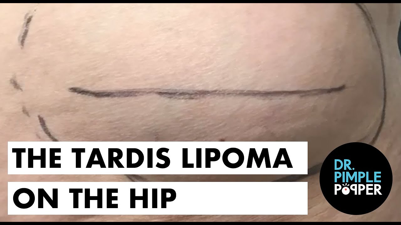 The Tardis Lipoma on the Hip