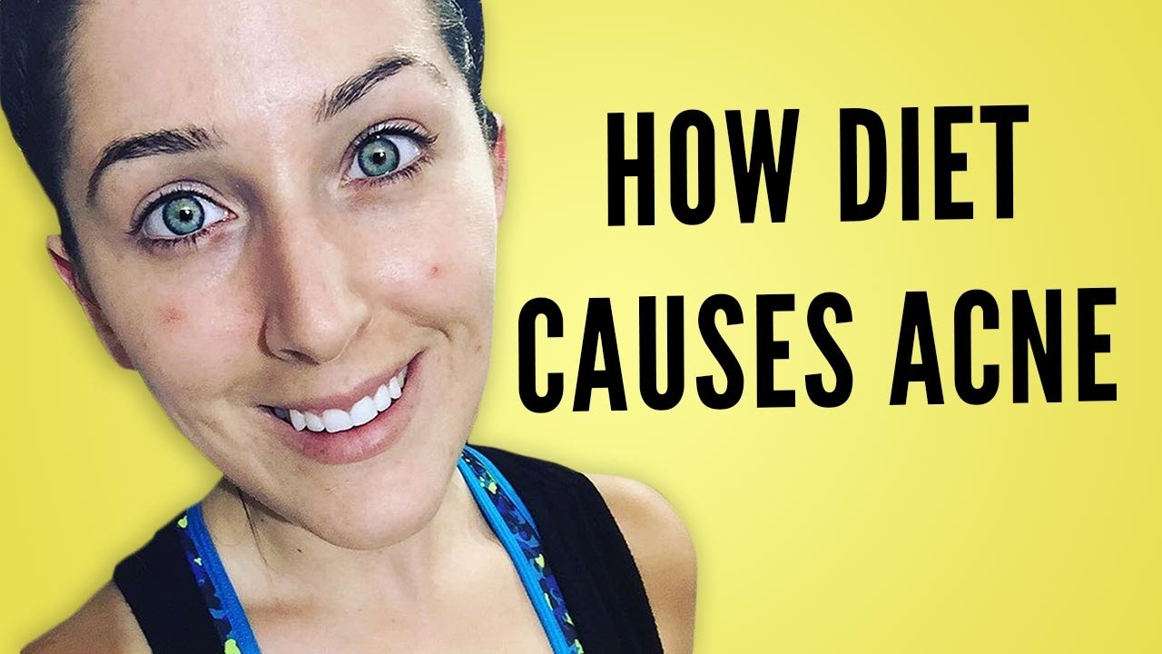 THE TRUTH ABOUT DIET AND ACNE