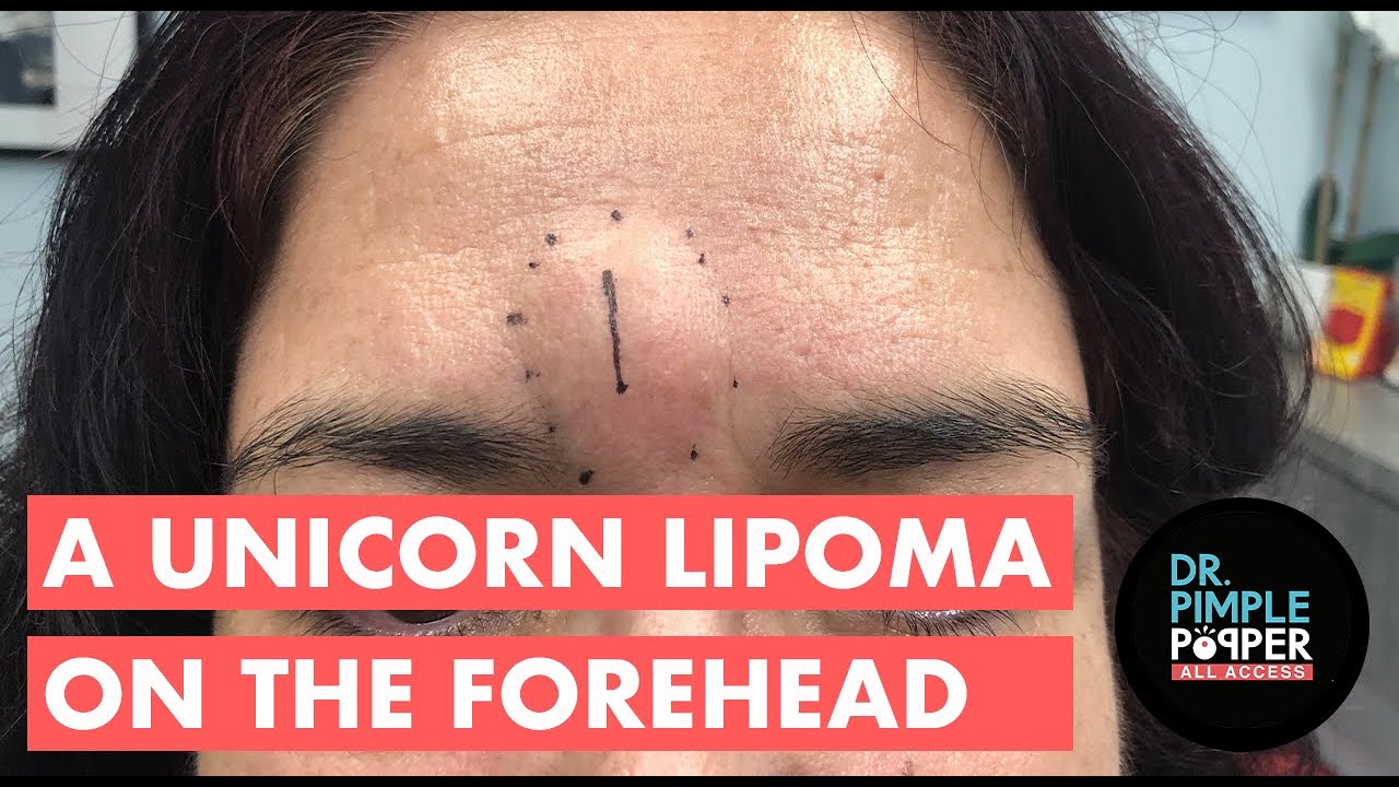 The Unicorn Lipoma