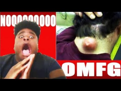 THE WORLDS BIGGEST PIMPLE EVER! ZIT PIMPLE POPPING REACTION VIDEO CHALLENGE SCARY!!