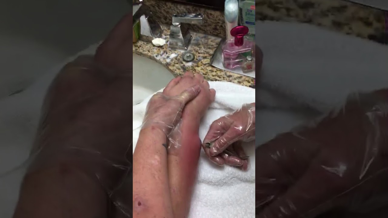 The worst boil popping ever , pus shooting out !