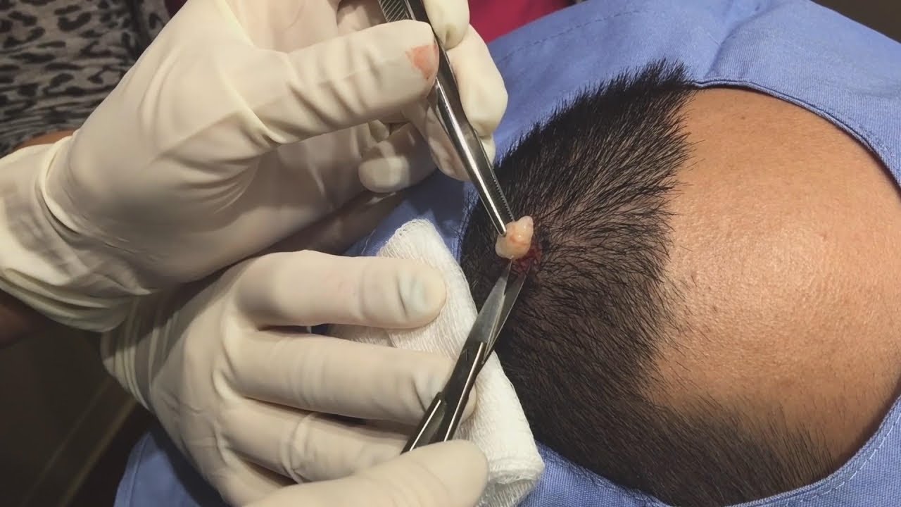 This Cyst & Blackhead Are No Match for Dr. Pimple Popper