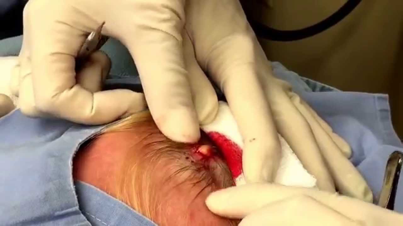 This cyst had triplets!! Pilar cyst surgery on scalp For medical education- NSFE.