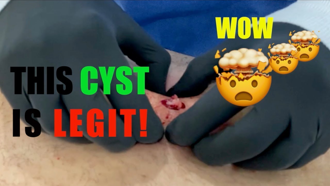 THIS CYST IS LEGIT!