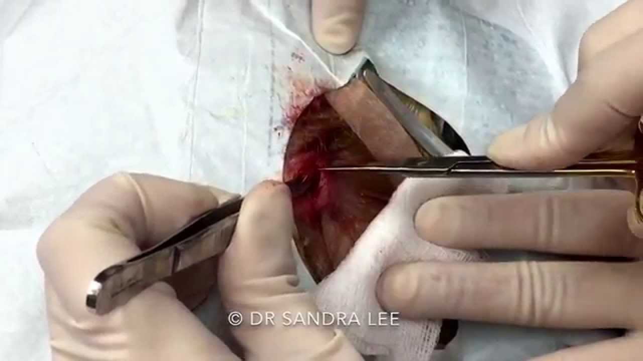 This. Is a GREAT pilar cyst extraction. For medical education- NSFE.