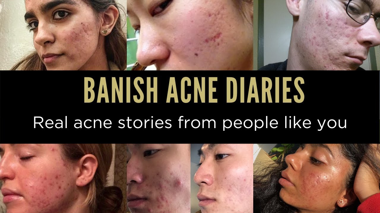 THIS IS MY ACNE STORY – BANISH ACNE DIARIES