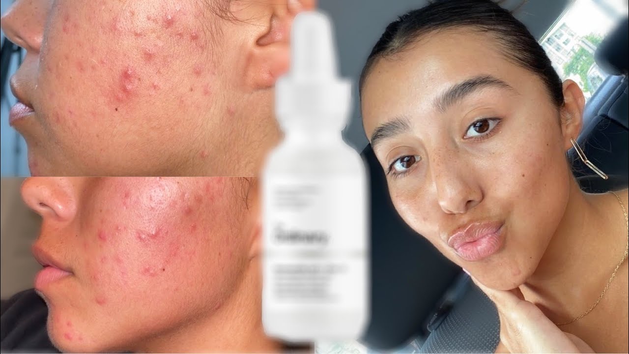 This ONE Product Cleared My Cystic Acne and Acne Scars! | Ronni Rae