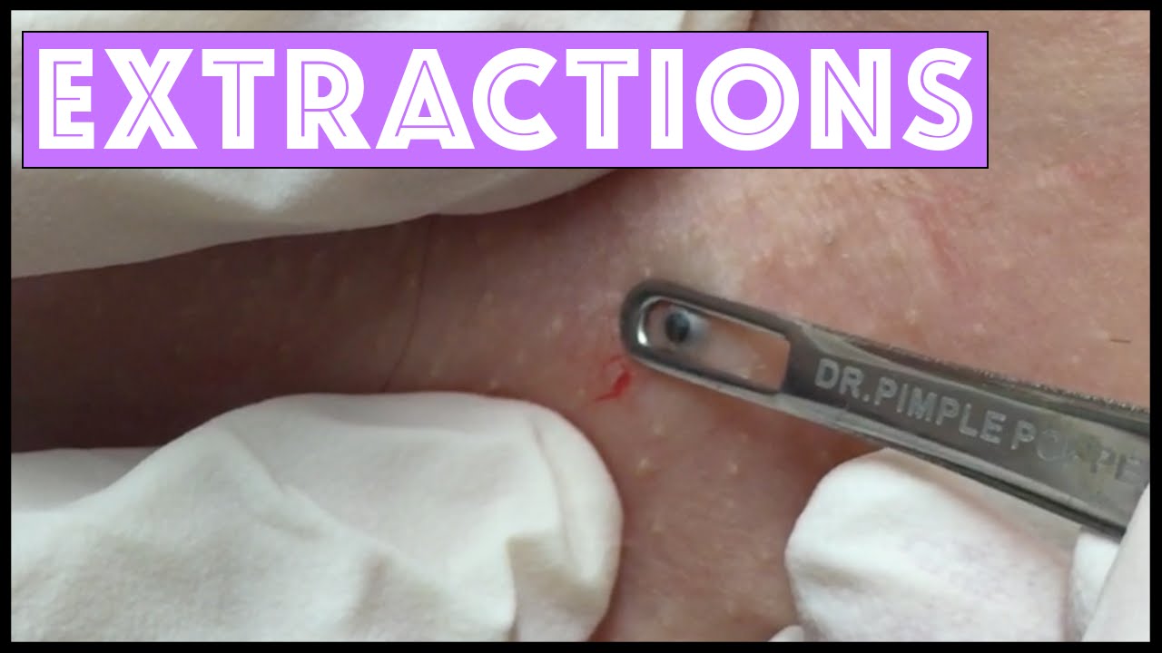 This Week’s Extractions!