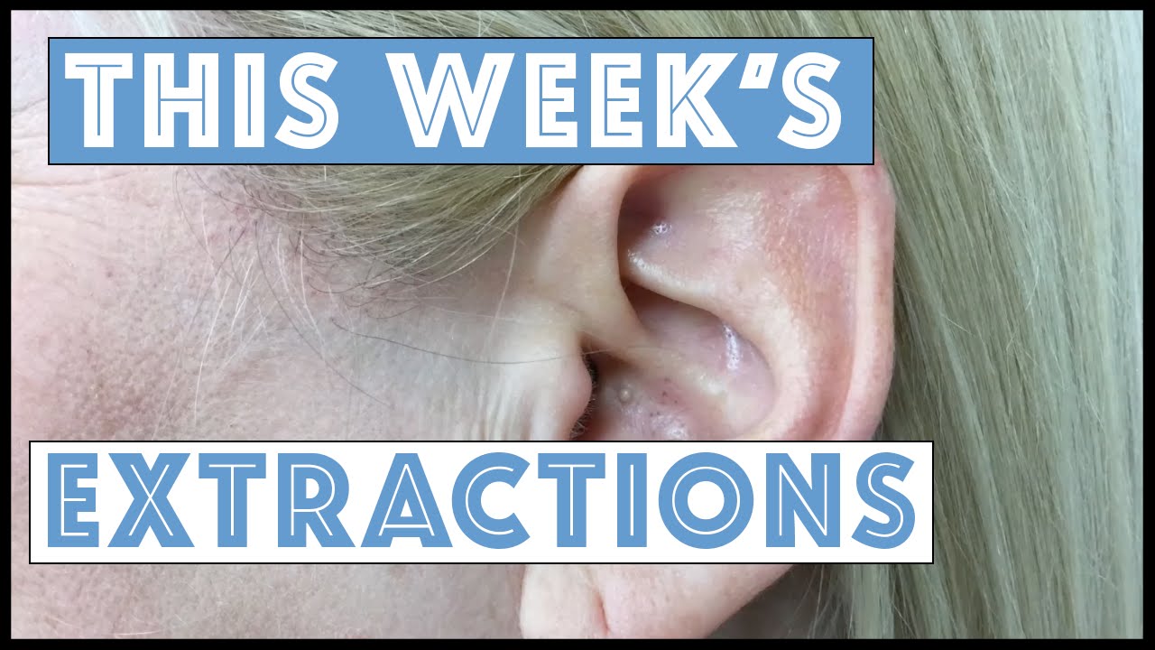 This Week’s Extractions!!