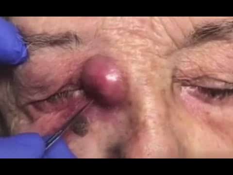 Three levels – Gross Pimple Popping