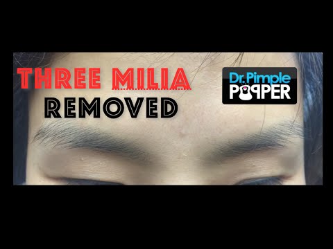 Three milia extracted on the face