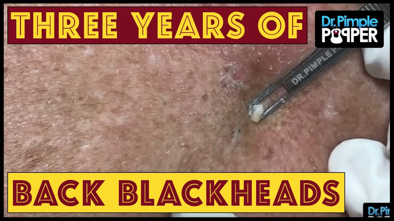 THREE years of Blackheads on the Back, & a Big Seborrheic Keratosis!