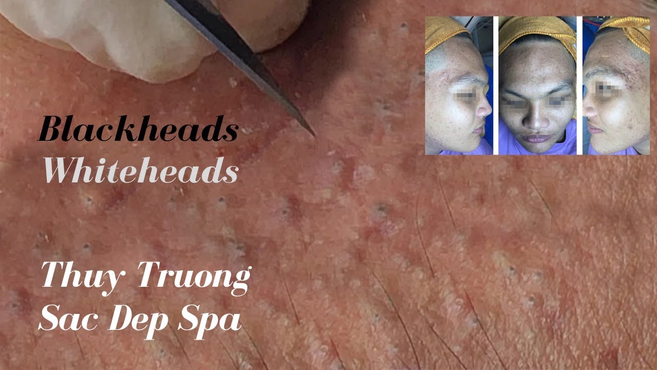 Thuy Truong removes her customers' blackheads and whiteheads