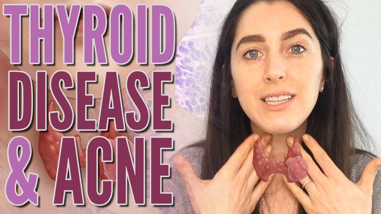 Thyroid Disease Versus Acne