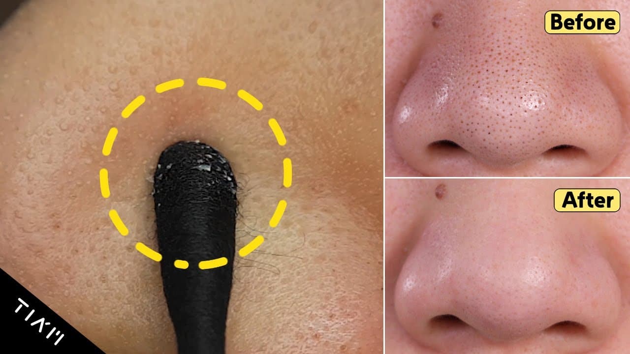 [TIA’M] Melt and Remove Blackheads In 10 Minutes!