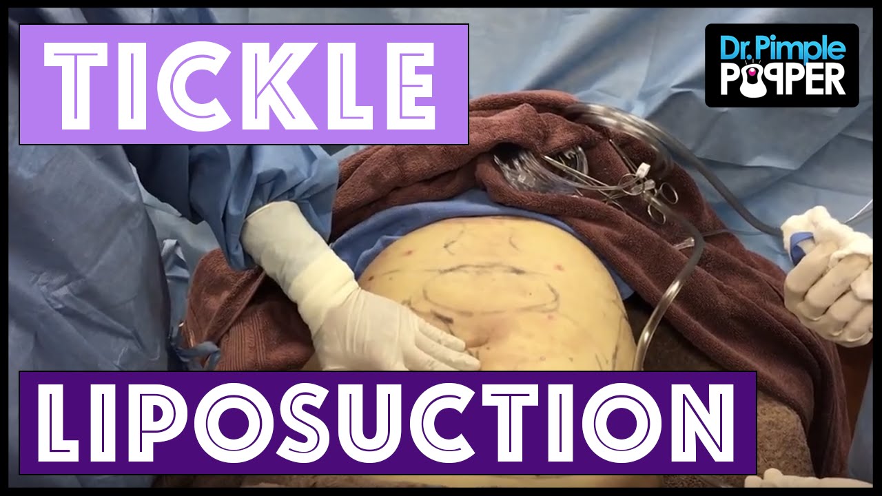 Tickle Liposuction by Dr Pimple Popper:  One of my favorite procedures to do!