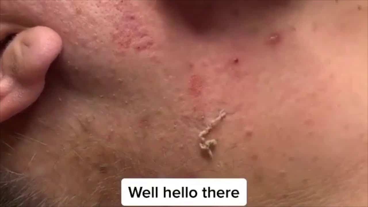 TikTok Pimple Popping Compilation #6 (Pimples, Blackheads, And Myxoid Cysts) Must See!!!