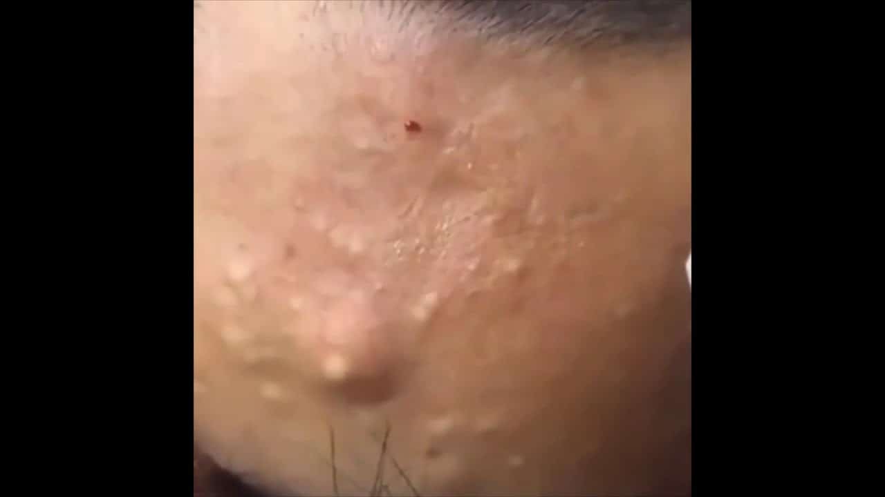 TikTok Pimple Popping Compilation #3 (Big Pimples, Blackhead Extractions, and HUGE CYSTS!) MUST SEE!