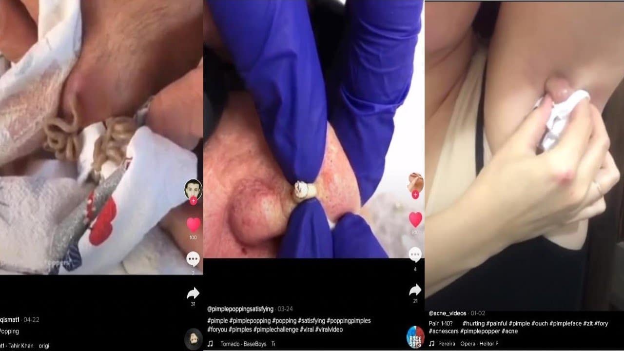TIKTOK Satisfying Pimple Popping Compilation! Cysts, Blackheads and more! #pimplepop