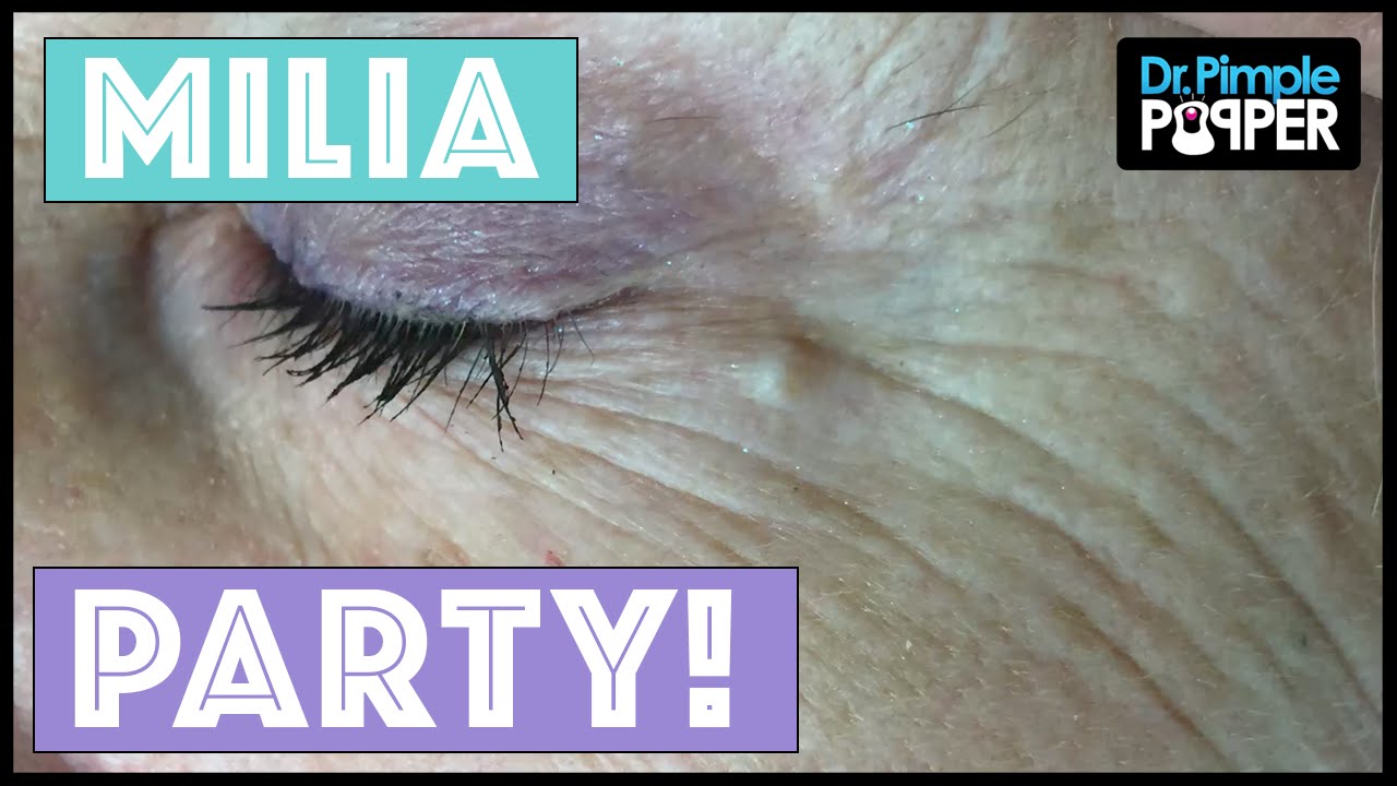Today’s Milia Extractions | Dr. Pimple Popper