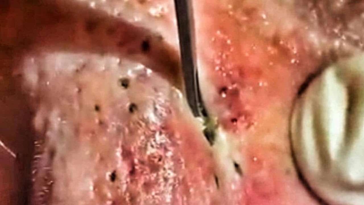 Tony's Top Three Cyst Pops and Pimple Pop of the Year