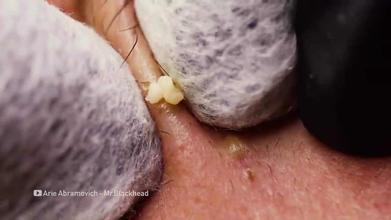 Top 10 Blackhead and Pimple Popping Searches! BIG Pimple Popping Compilation – What Are Comedones!