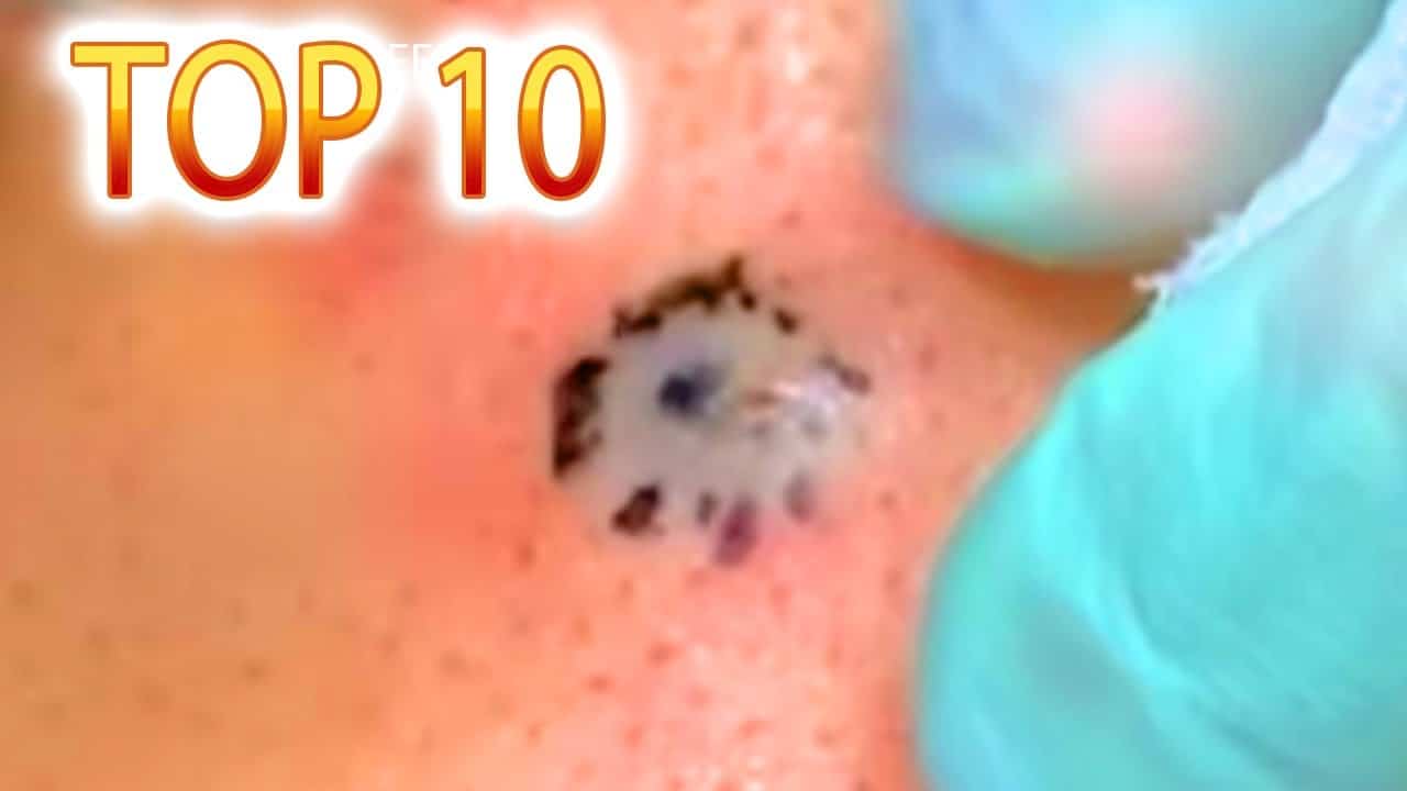 Top 10 Cysts, Blackheads, DPOWs, Big Pimple Pops and Zits