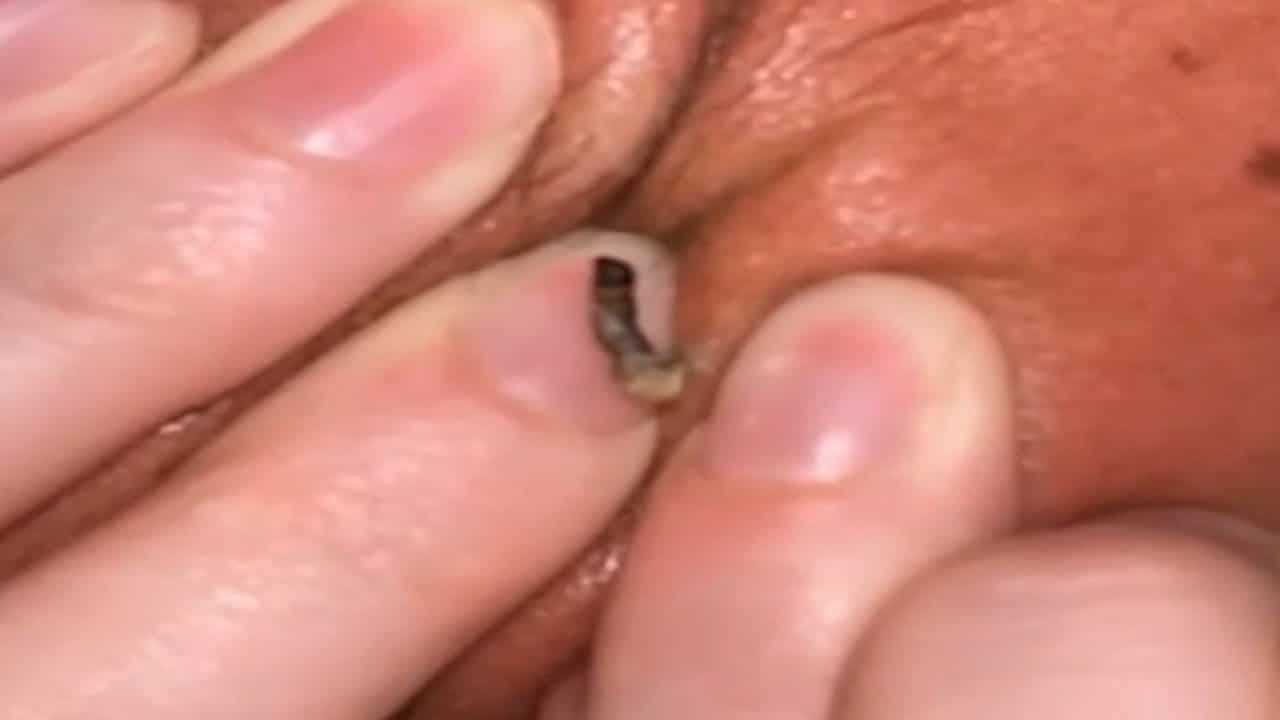 Top 10!  Dilated Pores, Spreading Blackheads and Cluster Blackheads!  Pimple Pops
