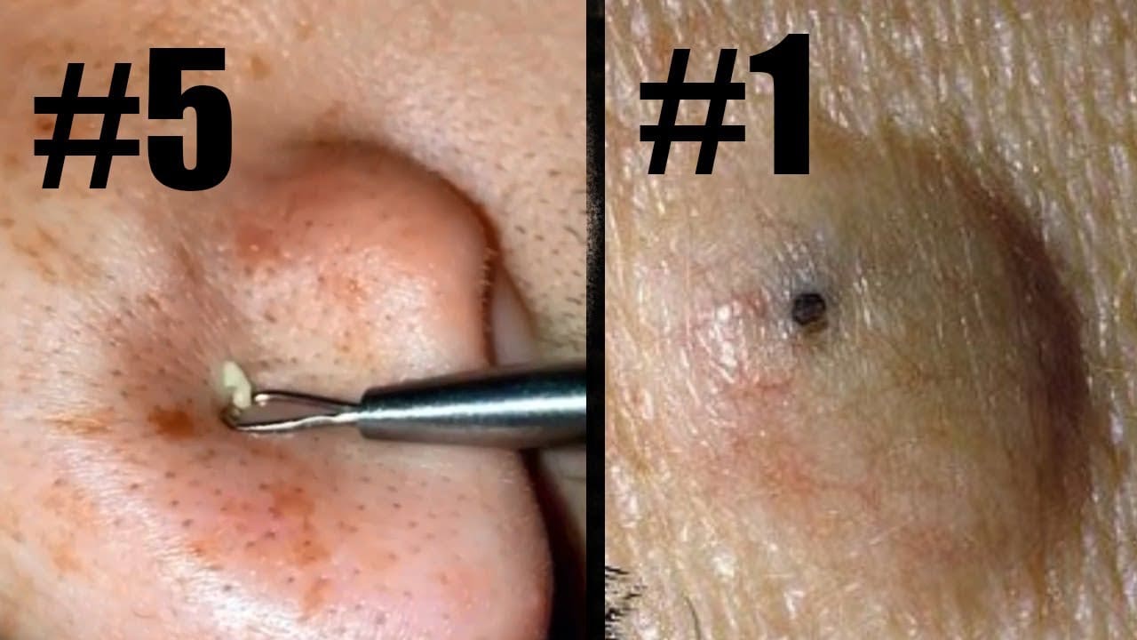 Top 10 Instagram Pimple Pops!  Blackheads, Pimples, Comedones and Chin Zits