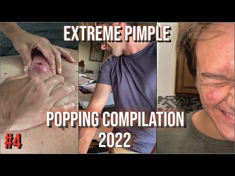 TOP 10 PIMPLE POPPING AND BLACKHEAD REMOVAL COMPILATION #23 – Best Pimple Popping Videos 2022