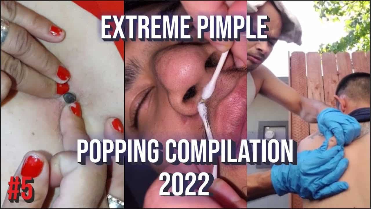 TOP 10 PIMPLE POPPING AND BLACKHEAD REMOVAL COMPILATION #4 – Best Pimple Popping Videos 2022
