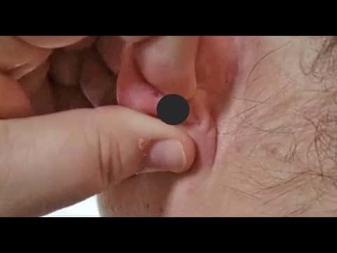 Top 10 Pimple Pops, Summer 2020!  Pimple Popping, Blackheads and Zits Poppers