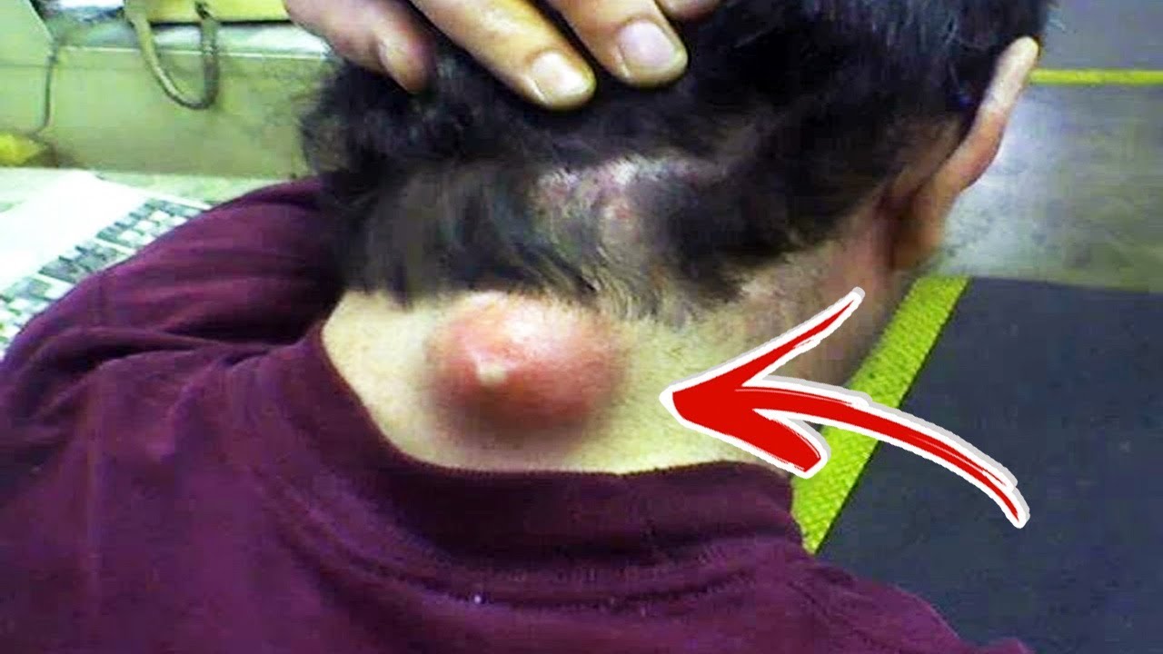 Top 10 Satisfying Pimple Popping Videos
