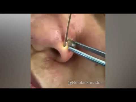 Top 15 viral pimple popping puss removal!! SOOO GROSSS!!