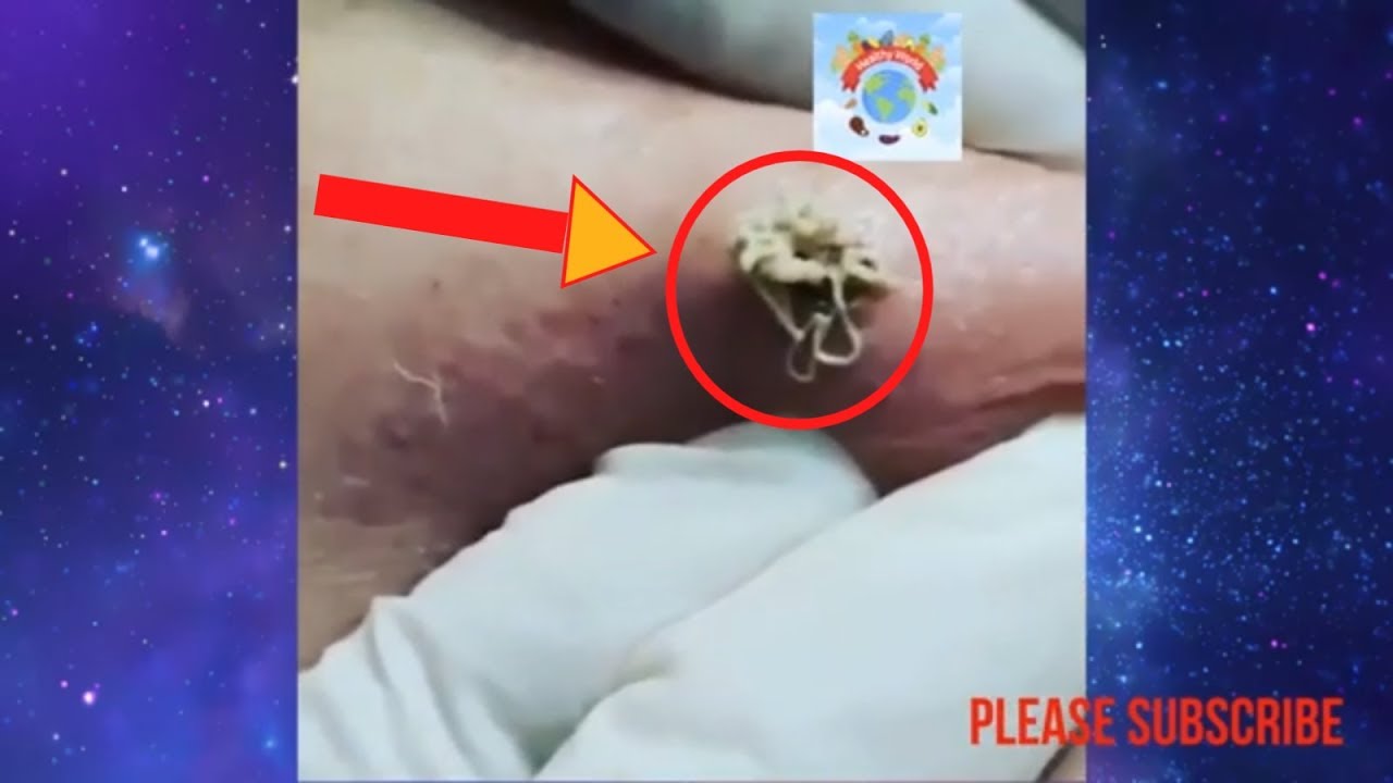 Top 3 Biggest and Scarry Blackhead on the world 2019