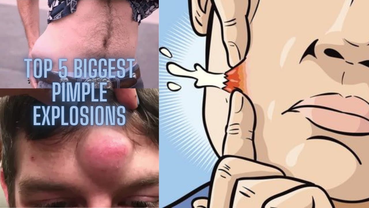 Top 5 Biggest Pimple Popping Explosions Ever
