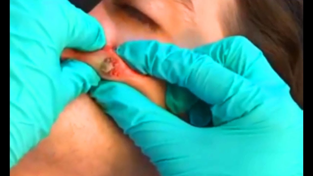 Top 5 Cysts of All Time – 2019 Edition