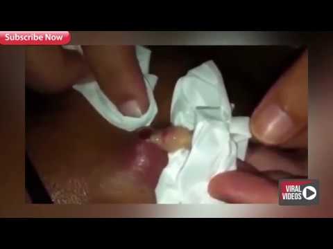 Top 5 Cysts! Pimple Popping! Cyst Skin compilation! Most popular Cysts