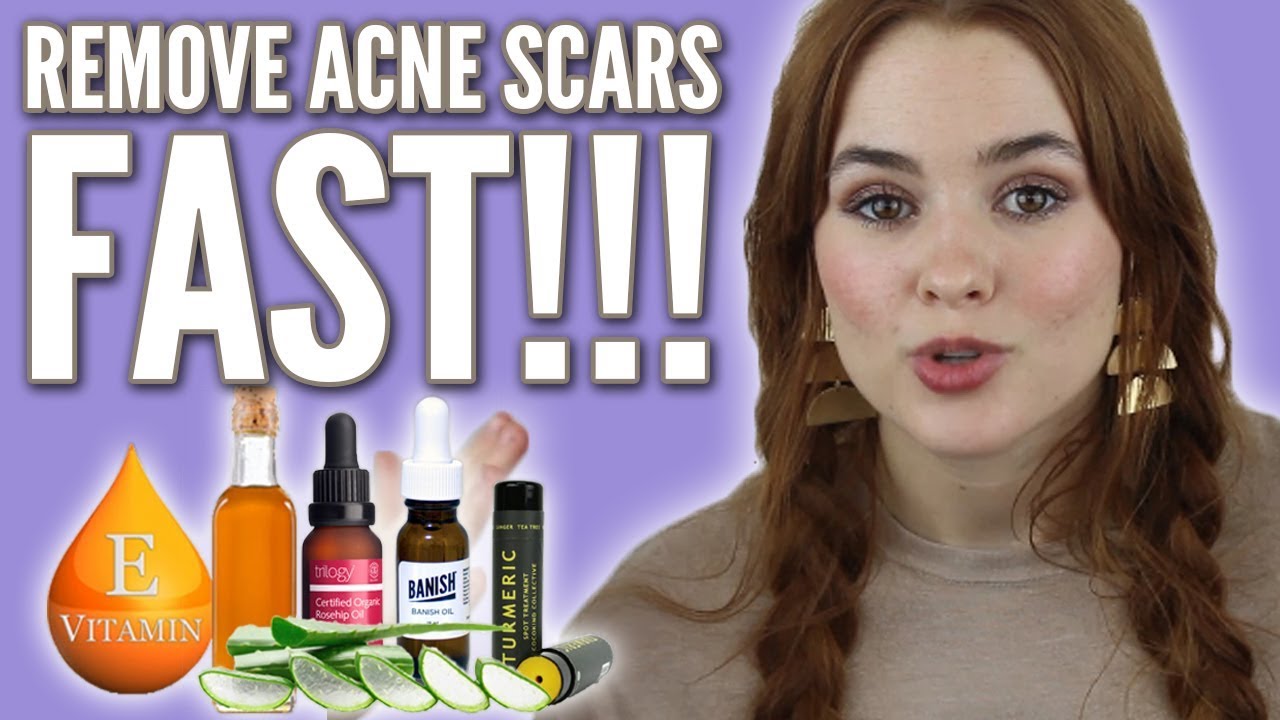 Top 5 Ways to Fade Post Acne Marks fast!